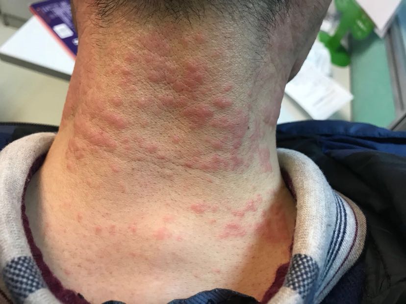 1、膏藥過敏怎么辦？