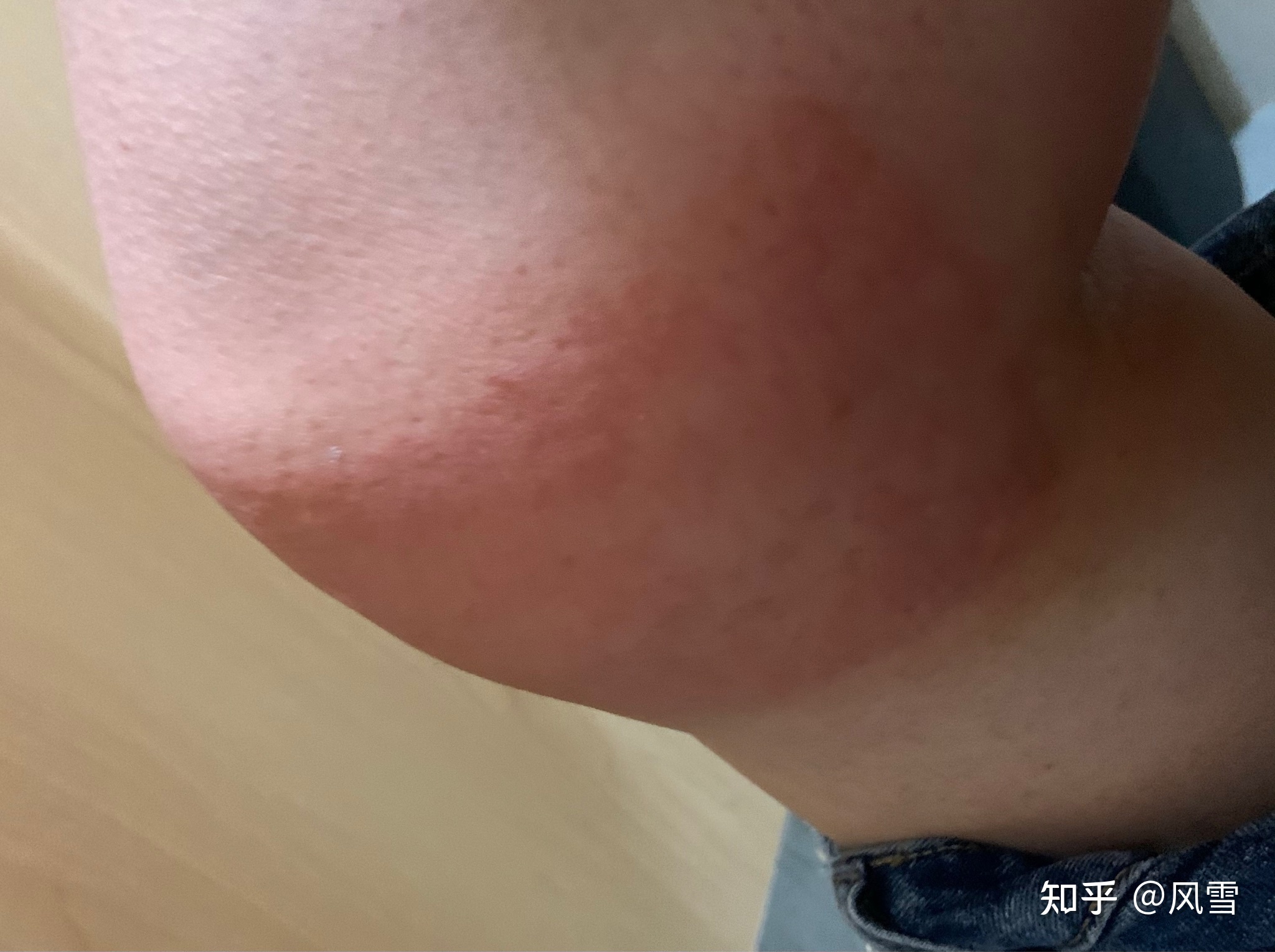 1、貼膏藥過(guò)敏癢紅腫怎么辦？
