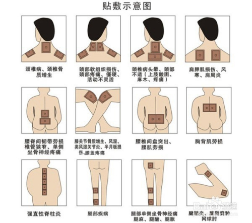 1、肩痛買(mǎi)什么膏藥可以貼？