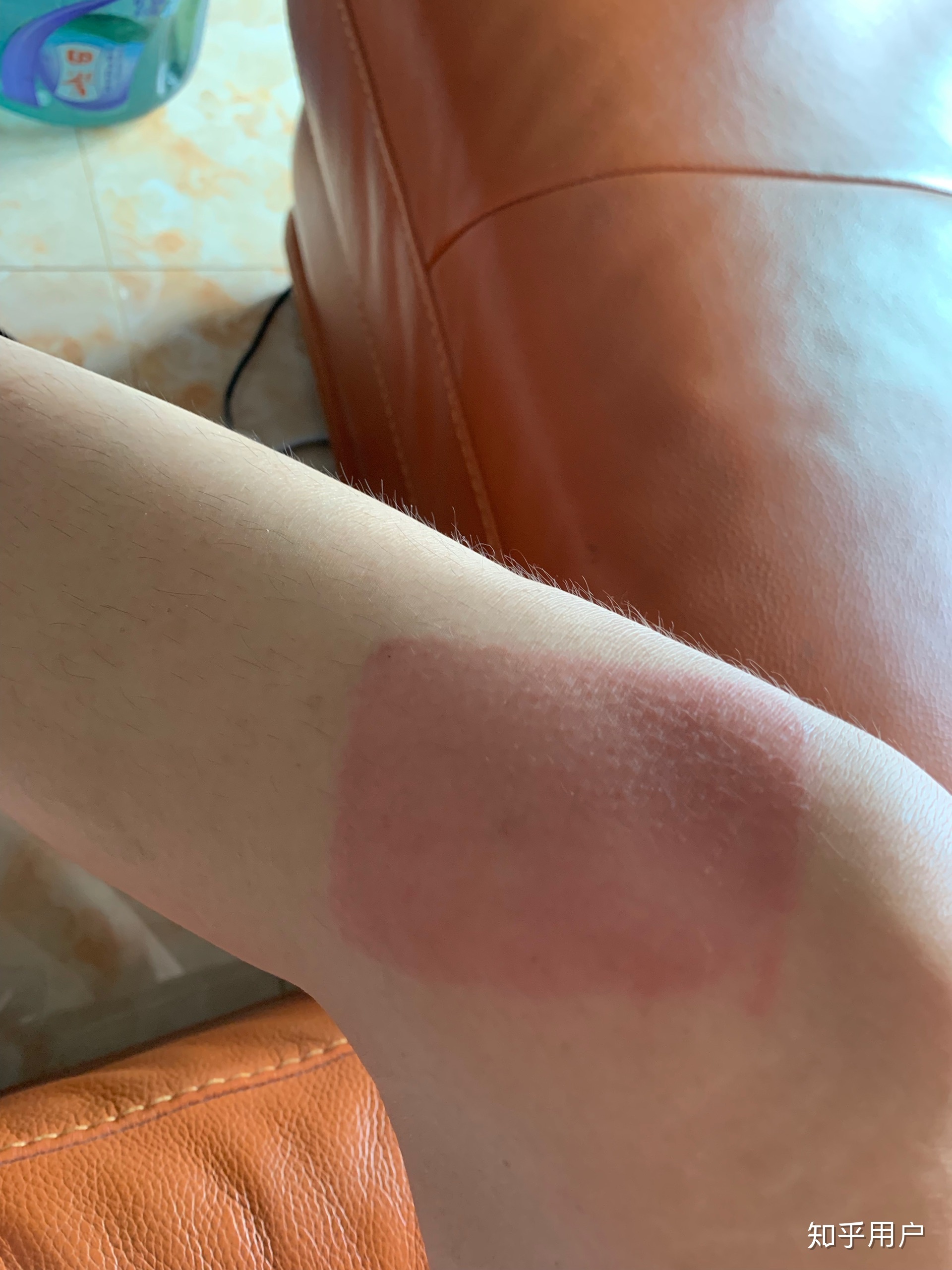 2、貼膏藥的地方有很多紅疙瘩，好不好？
